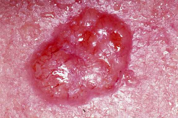 picture of basal cell carcinoma 