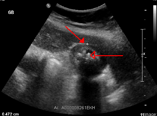 Diagnosis of cholecystitis using ultrasound for use in your Nursing Care Plan. Cholecystitis with cholelithiasis. Ultrasound showing inflammation of the gallbladder with presence of gallstones. 