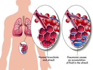 Alveoli with accumulated fluid.