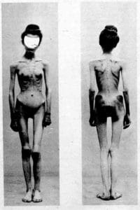 Physical toll that anorexia nervosa takes on the human body. Image used for nursing care plan (ncp) for eating disorders 