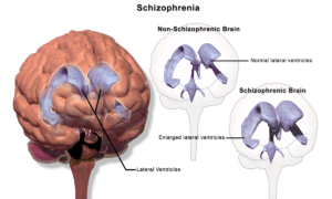 Image shows the physiology of a brain with schizophrenia for use in understand the creation of a schizophrenia nursing care plan (ncp) 