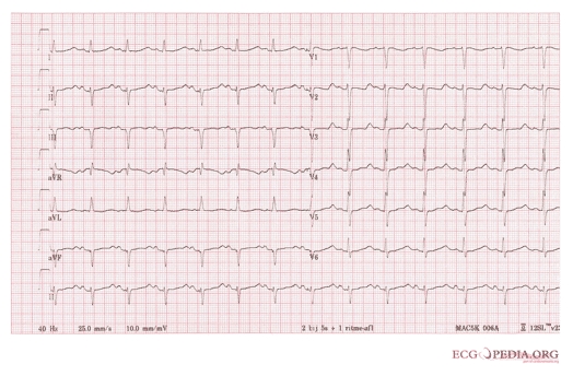 hypokalemia ekg graph