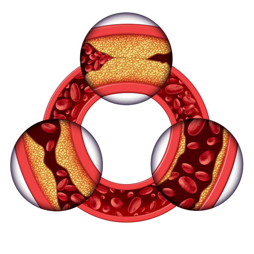 coronary artery disease nclex review for nursing students image of progress